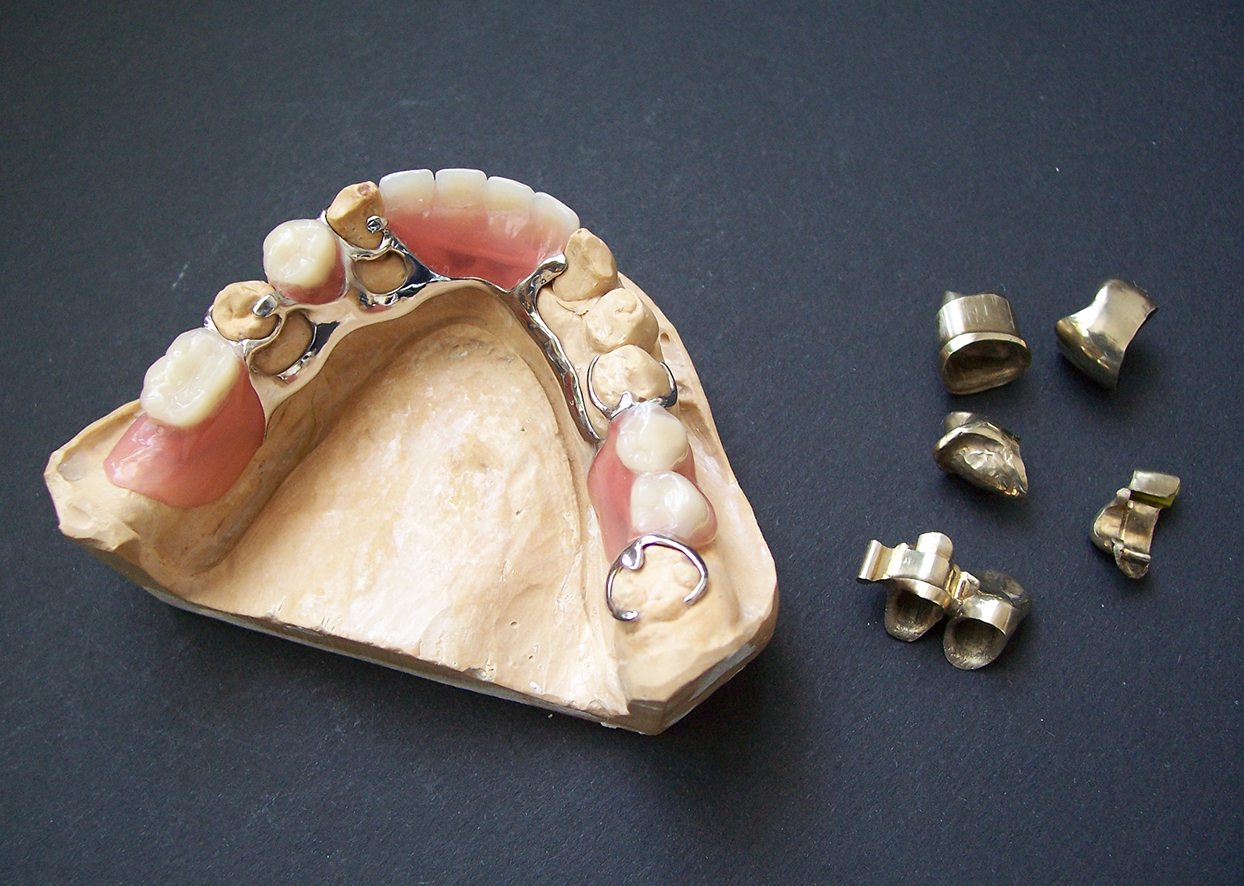 詰め物・被せ物