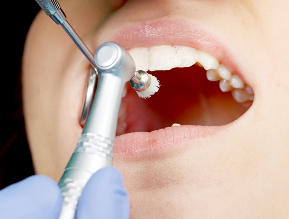 予防歯科のメリット